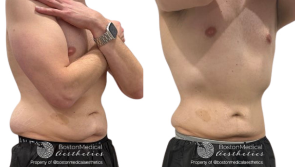 CoolSculpting Before & After Photo