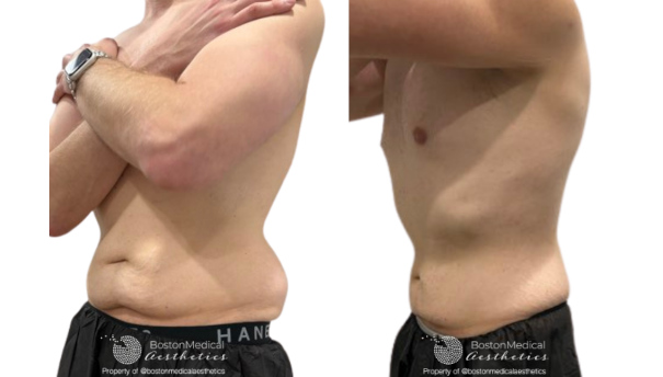 CoolSculpting Before & After Photo