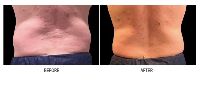 CoolSculpting Before & After Photo