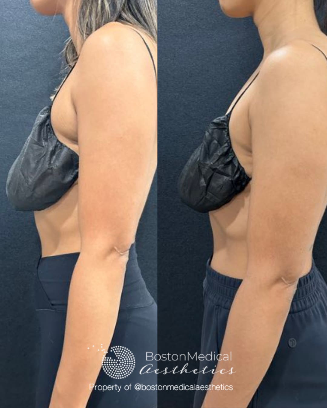 CoolSculpting Before & After Photo