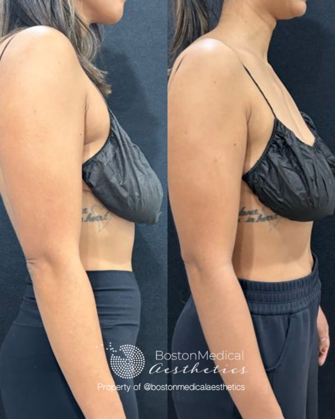 CoolSculpting Before & After Photo