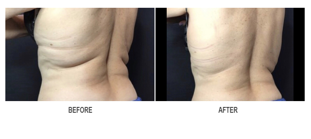 CoolSculpting Before & After Photo