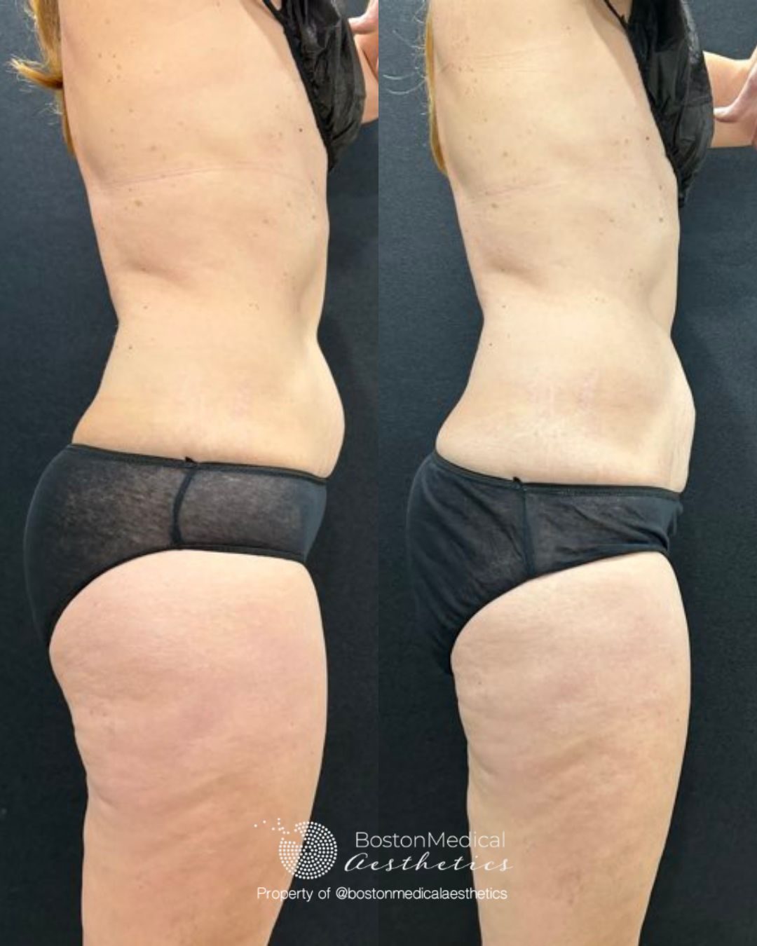 CoolSculpting Before & After Photo