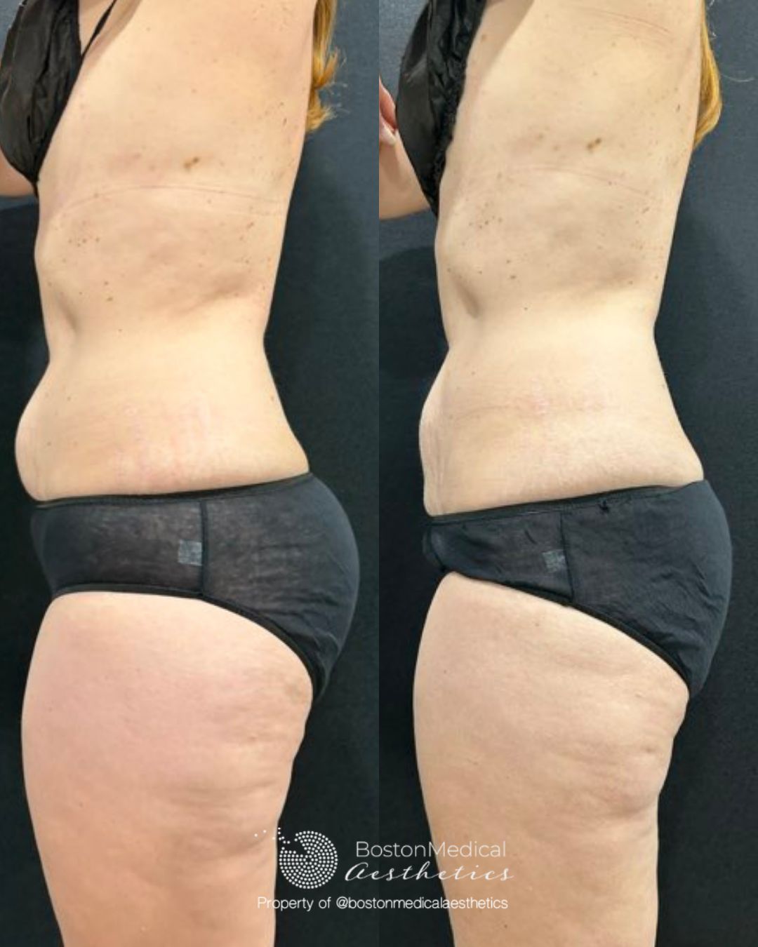CoolSculpting Before & After Photo