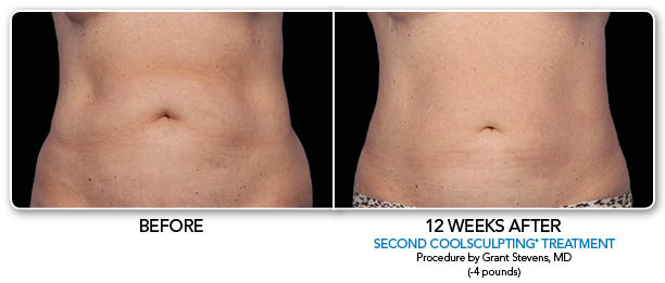 CoolSculpting Before & After Photo