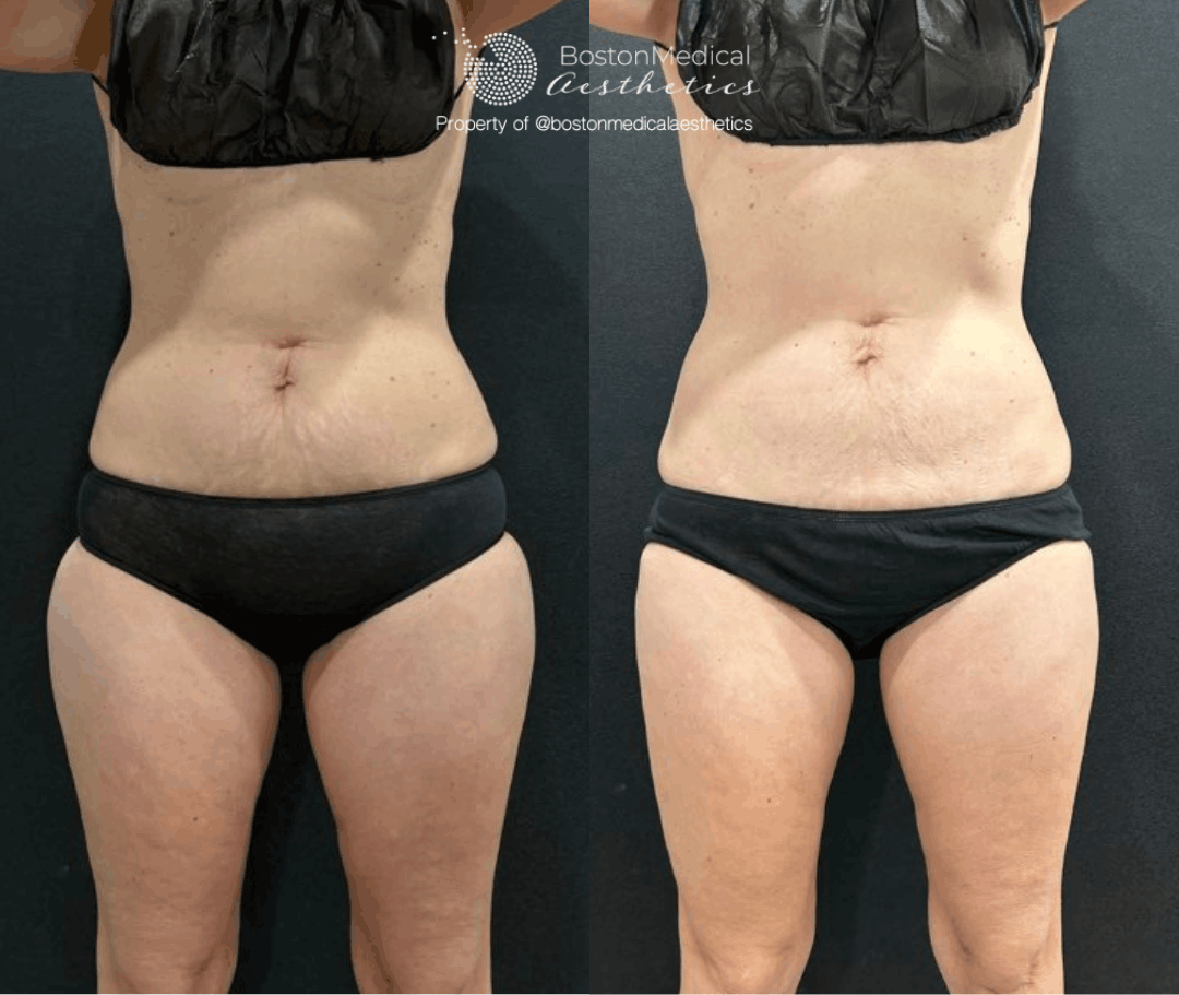 CoolSculpting Before & After Photo