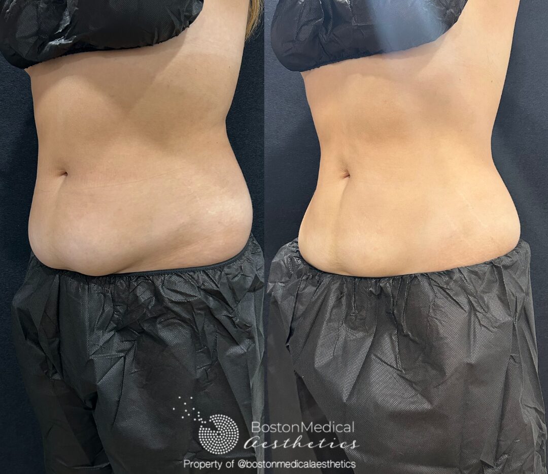 CoolSculpting Before & After Photo
