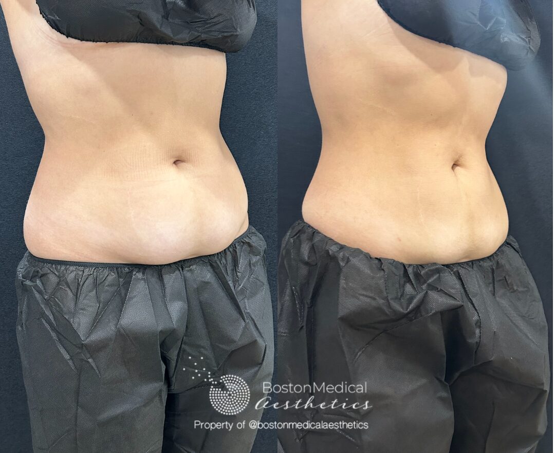 CoolSculpting Before & After Photo