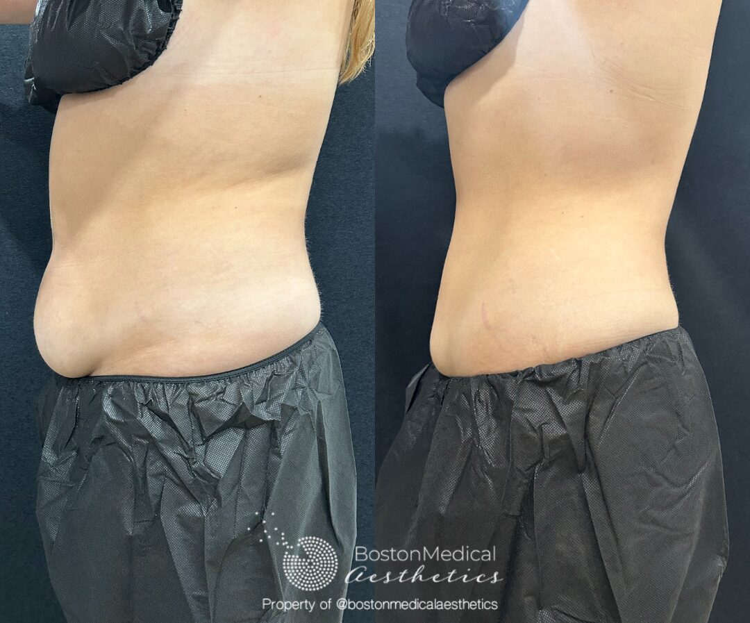 CoolSculpting Before & After Photo