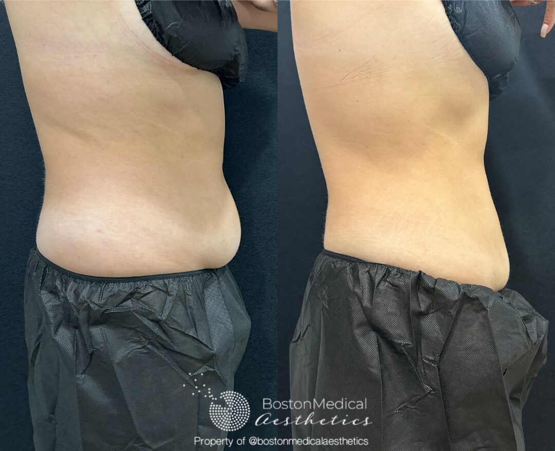 CoolSculpting Before & After Photo