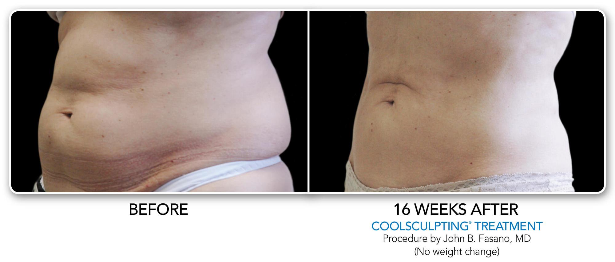 CoolSculpting Before & After Photo