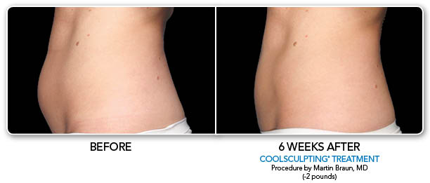 CoolSculpting Before & After Photo