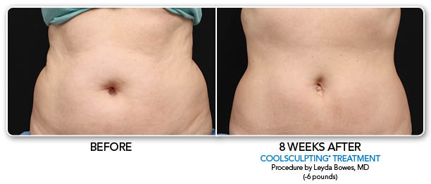 CoolSculpting Before & After Photo