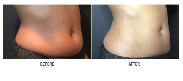 CoolSculpting Before & After Photo