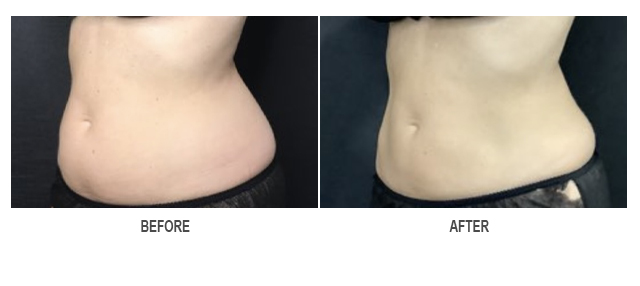 CoolSculpting Before & After Photo