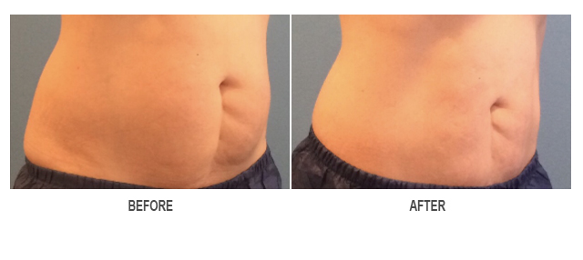 CoolSculpting Before & After Photo