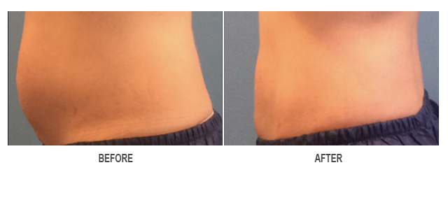 CoolSculpting Before & After Photo