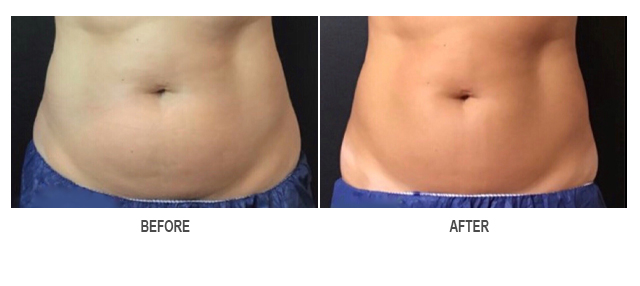 CoolSculpting Before & After Photo