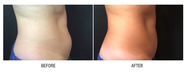 CoolSculpting Before & After photo