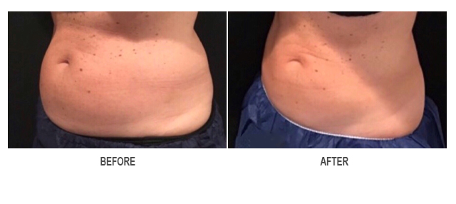 CoolSculpting Before & After Photo