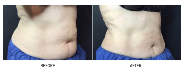 CoolSculpting Before & After Photo