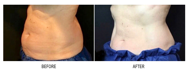 CoolSculpting Before & After Photo