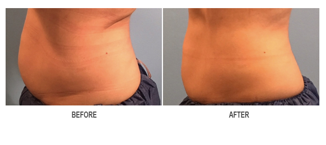 CoolSculpting Before & After Photo