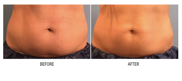 CoolSculpting Before & After Photo