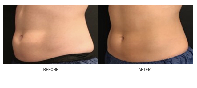 CoolSculpting Before & After Photo