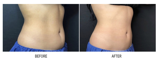 CoolSculpting Before & After Photo