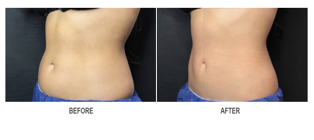 CoolSculpting Before & After Photo