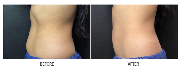 CoolSculpting Before & After Photo