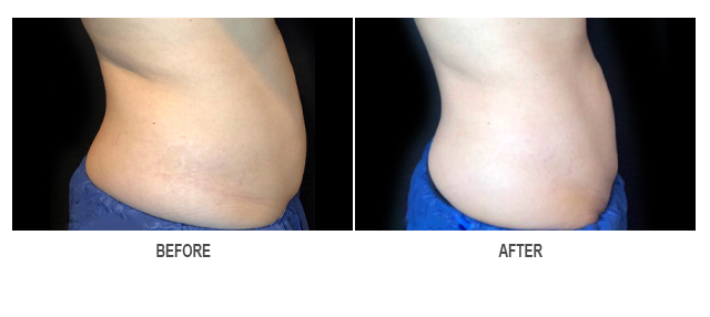 CoolSculpting Before & After Photo