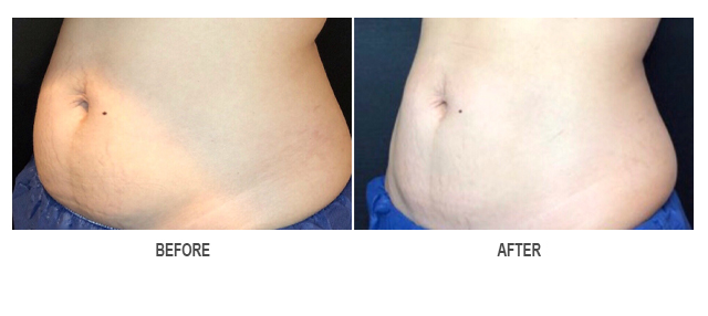 CoolSculpting Before & After Photo