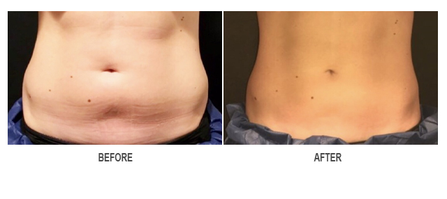 CoolSculpting Before & After Photo