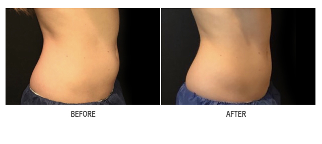 CoolSculpting Before & After Photo