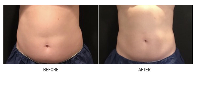 CoolSculpting Before & After Photo