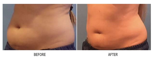 CoolSculpting Before & After Photo