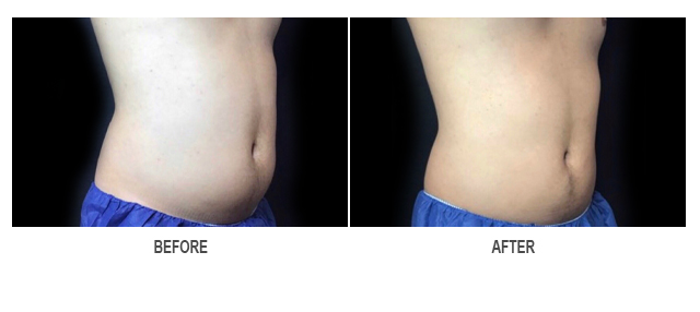 CoolSculpting Before & After Photo