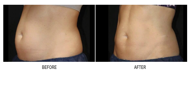 CoolSculpting Before & After Photo