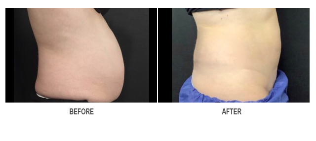 CoolSculpting Before & After Photo