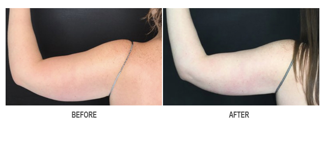 CoolSculpting Before & After Photo