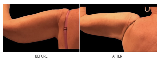 CoolSculpting Before & After Photo