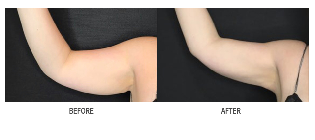 CoolSculpting Before & After Photo