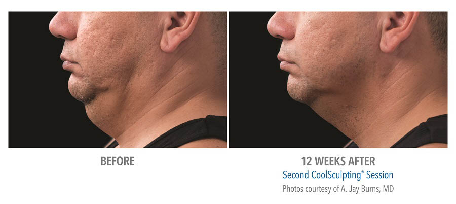 CoolSculpting Before & After Photo