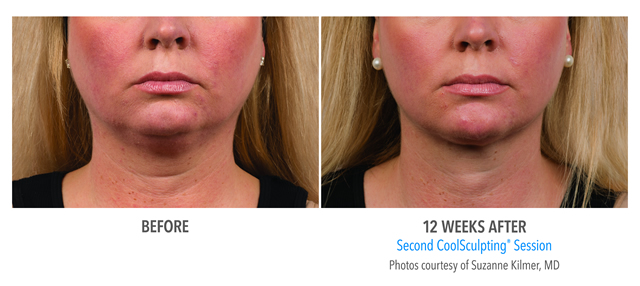 CoolSculpting Before & After Photo