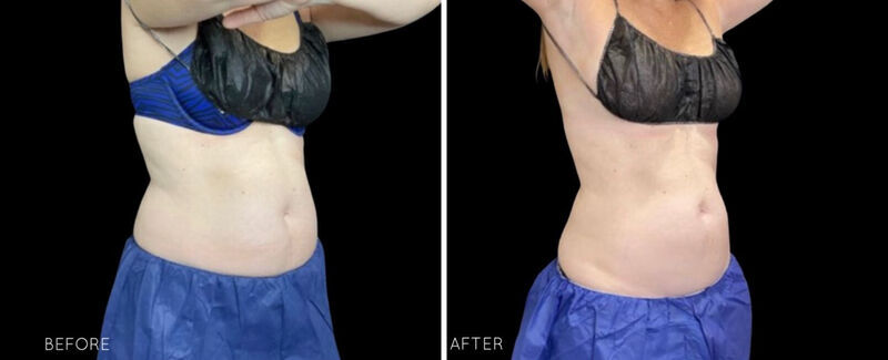 CoolSculpting Before & After Photo