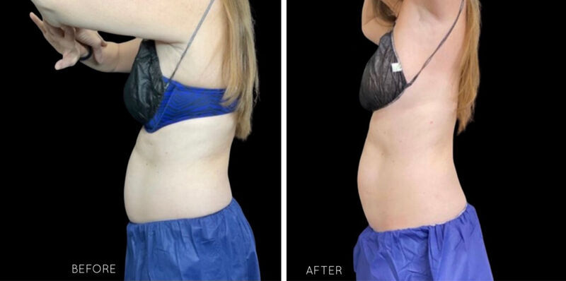 CoolSculpting Before & After Photo