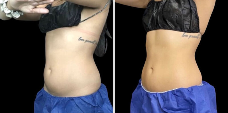 CoolSculpting Before & After Photo