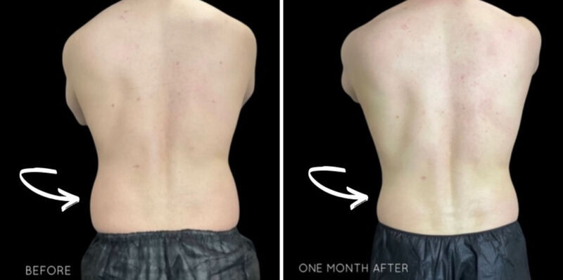 CoolSculpting Before & After Photo